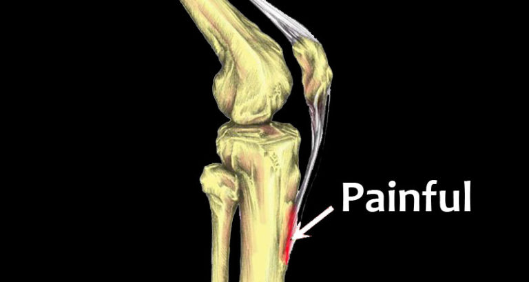 Osgood-Schlatter