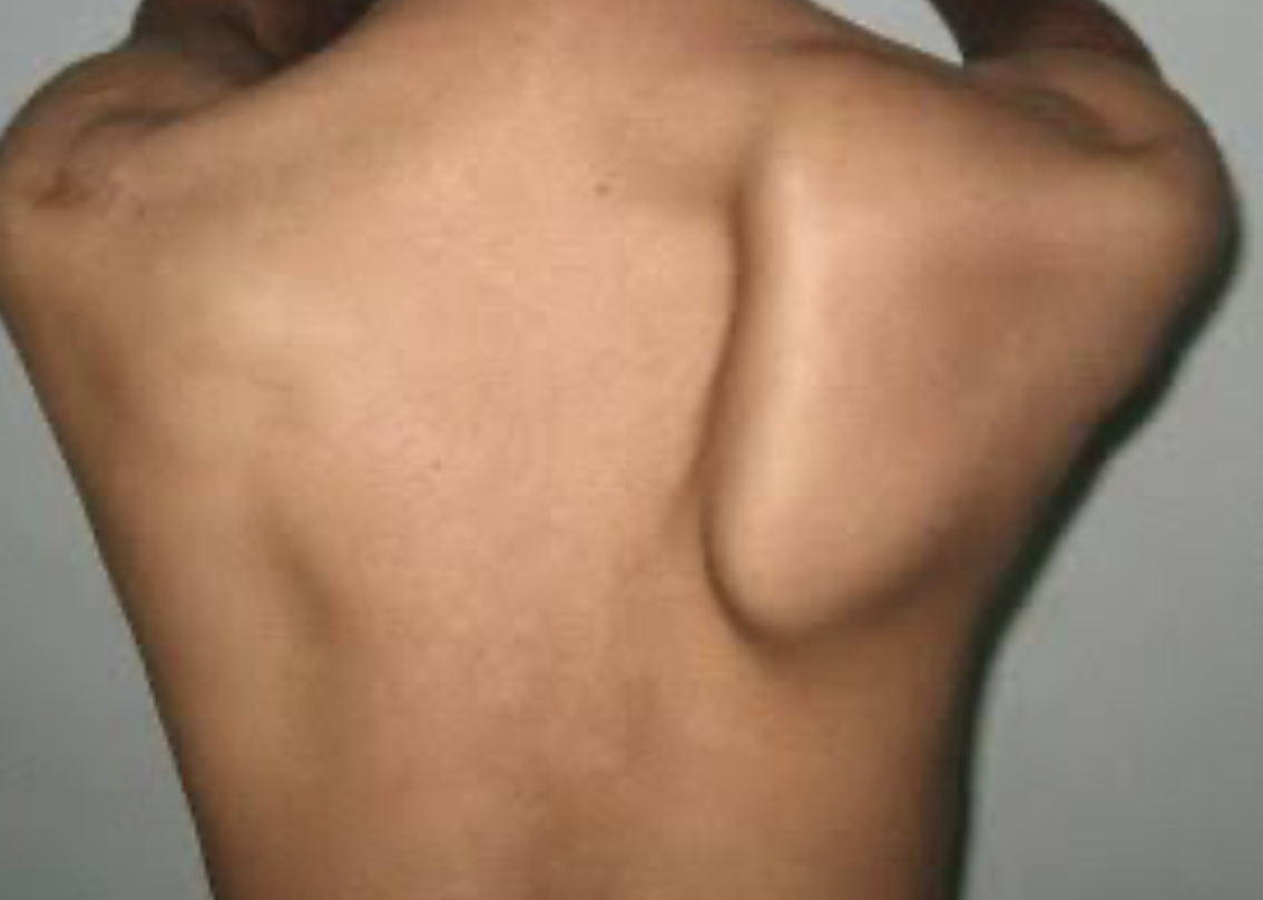 What Is Scapula Winging And How To Fix It