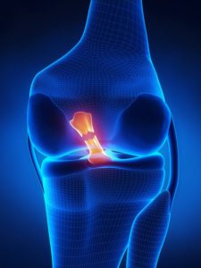 Read more about the article Your First Few Weeks of ACL Rehabilitation: What to Expect After Returning from the Hospital