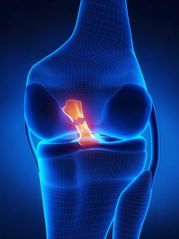 You are currently viewing Your First Few Weeks of ACL Rehabilitation: What to Expect After Returning from the Hospital