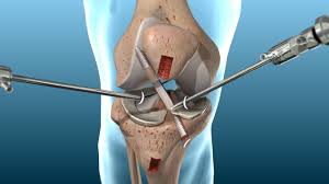 ACL post surgical taking place with instruments inside the knee