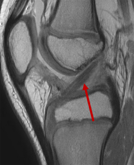 Read more about the article Post-Surgical Physiotherapy Services in Auckland: Your Guide to Recovery After Anterior Cruciate Ligament (ACL) Reconstruction