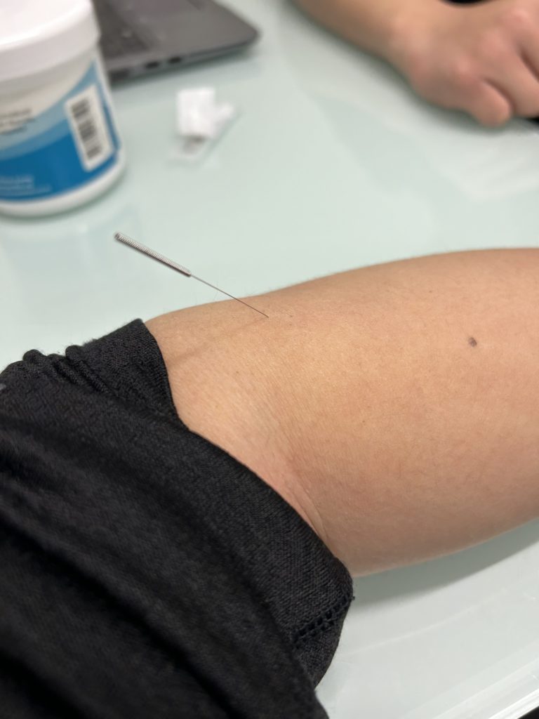 there is acupuncture needle inside a patients forearm